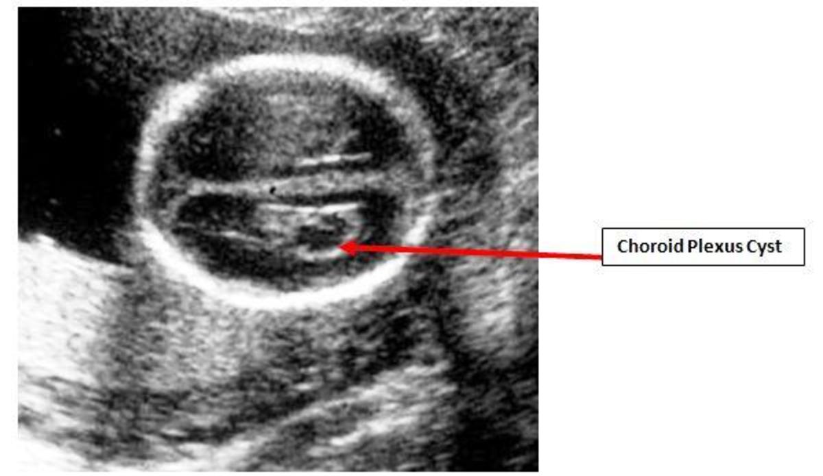 Choroid Plexus Cysts are Harmless HubPages