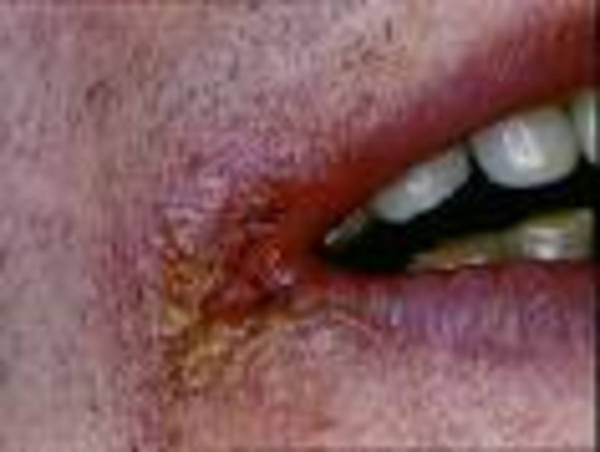 Splits at Corners of Mouth...Stop The Pain and Cure Angular Cheilitis