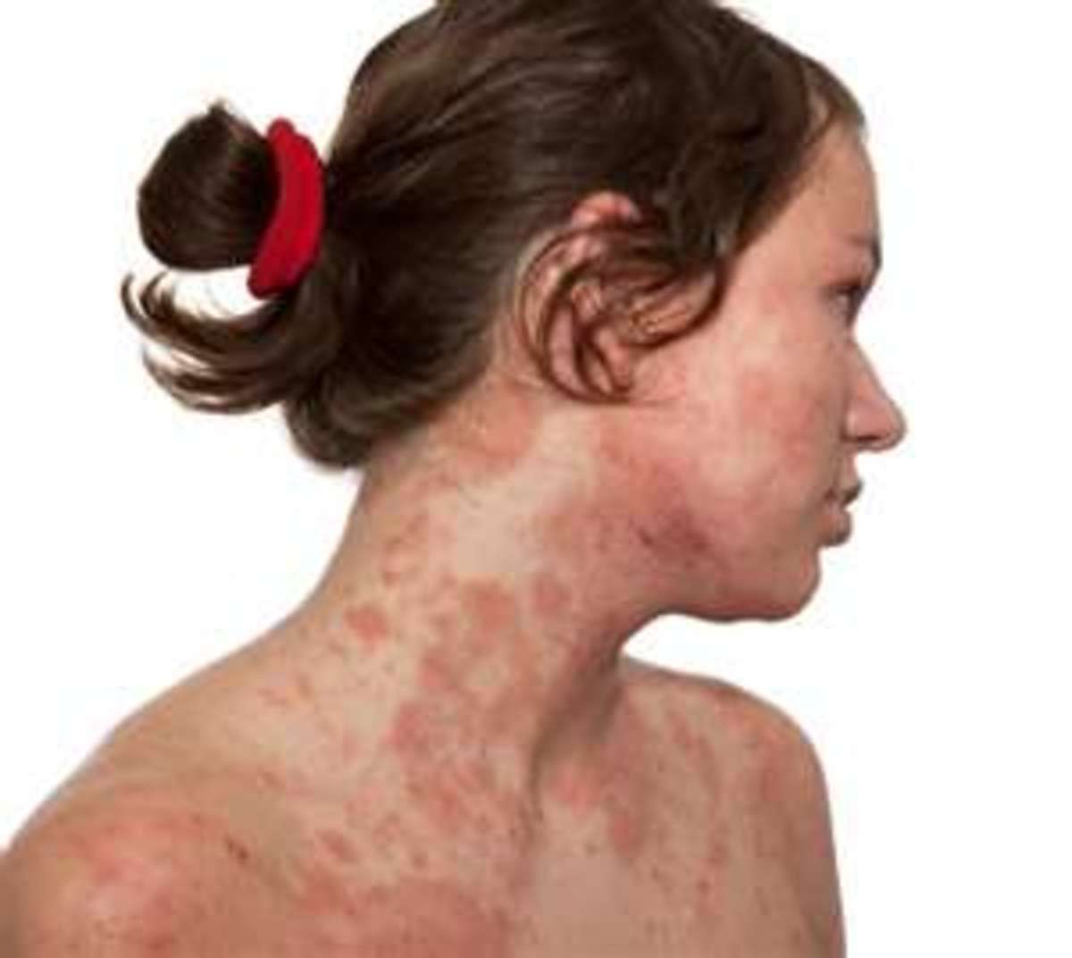 Stomach Baby Eczema, How to Stop the Itch Using Natural Beeswax and