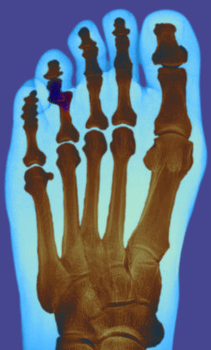 Symptoms You Have a Broken Pinky Toe or Stubbed Toe, Difference in