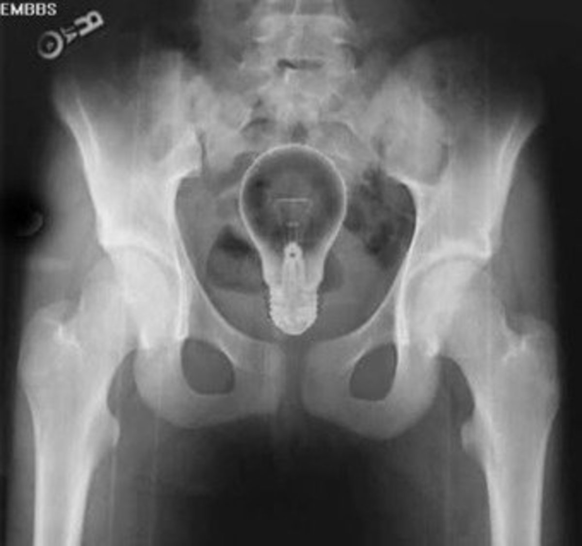 10 Most Shocking XRay Photos hubpages