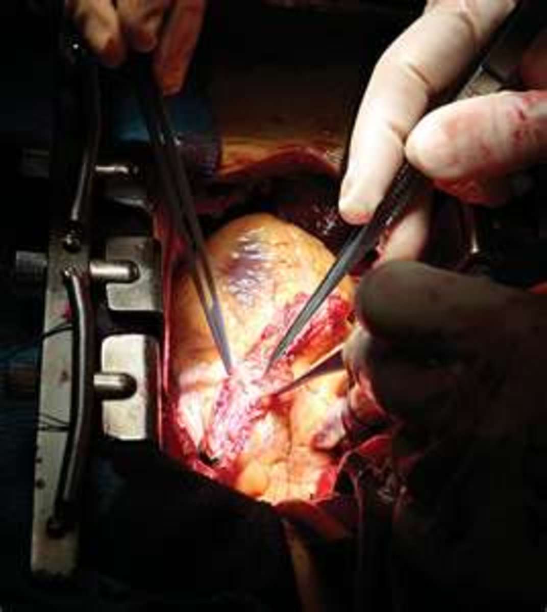 Part 1 What to Expect After Open Heart Surgery hubpages