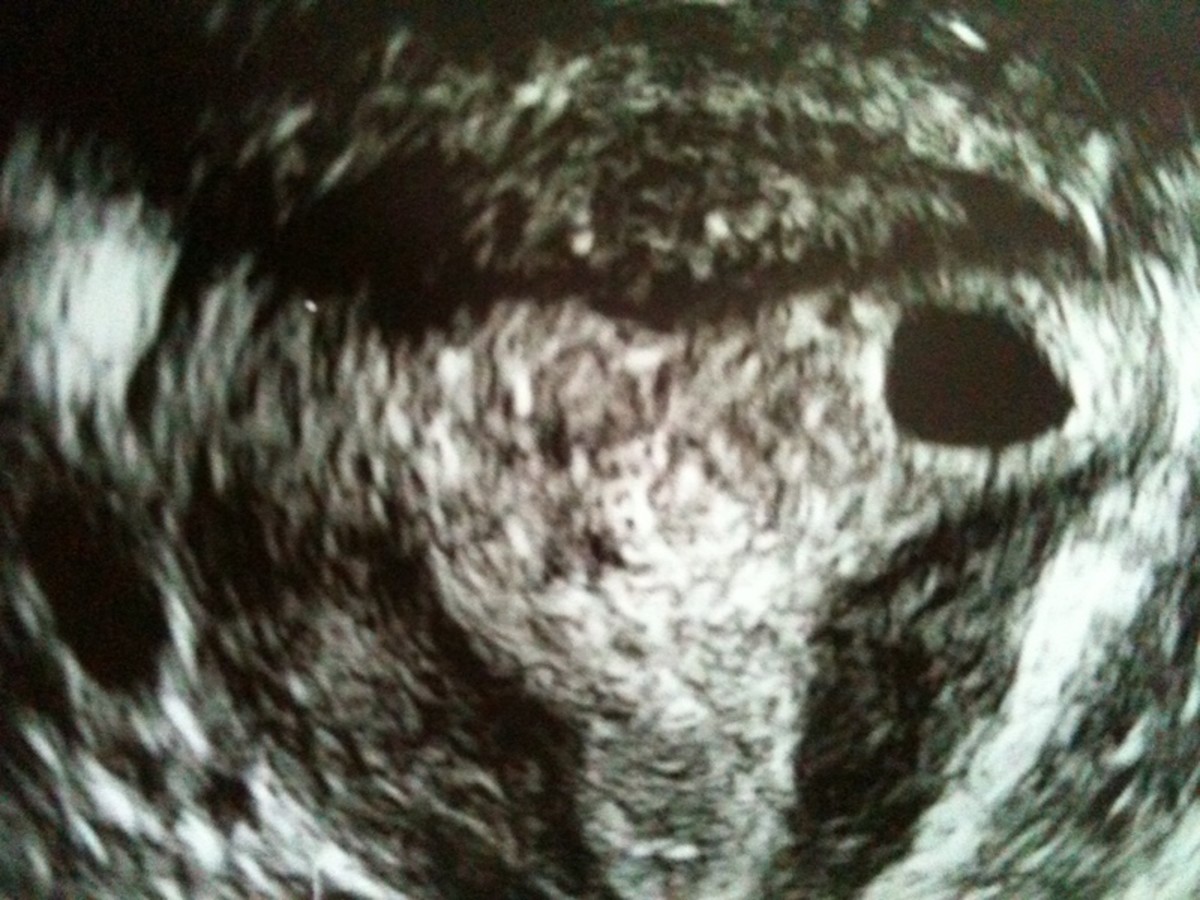 What is a Blighted Ovum? HubPages