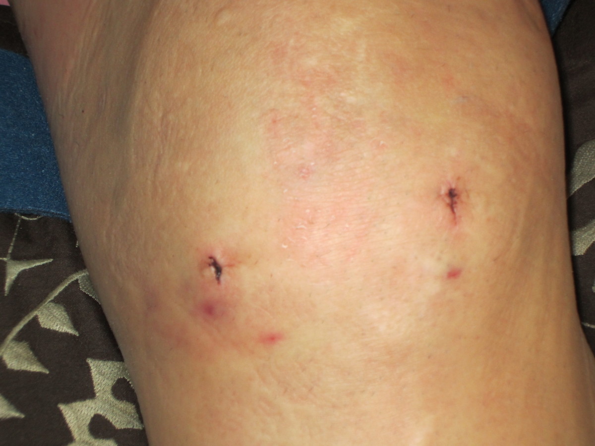 Causes of Pain After Knee Replacement Surgery