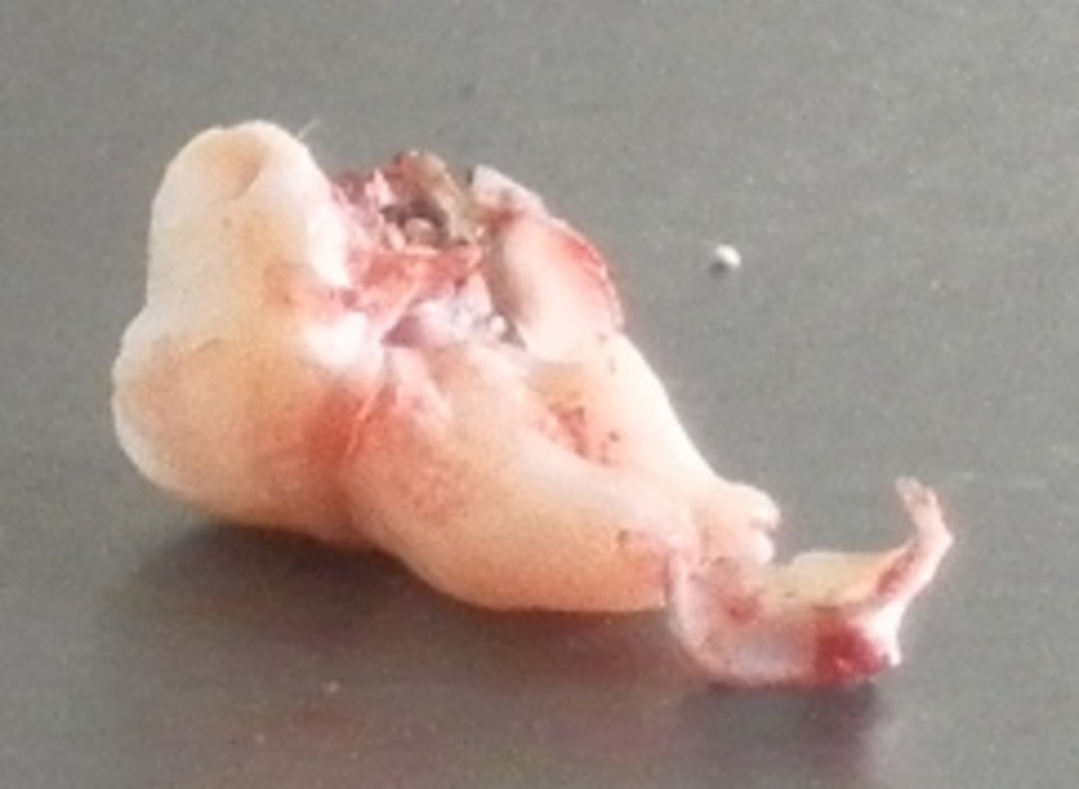 How to Recover Quickly After Having Your Wisdom Teeth