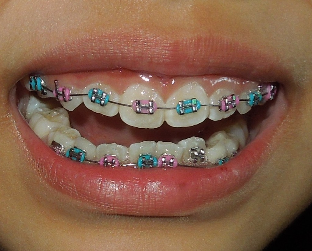 Braces for Kids How Orthodontics Work HubPages