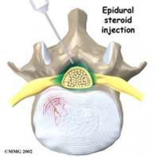 Injections for back pain and neck pain Indications and Expectations