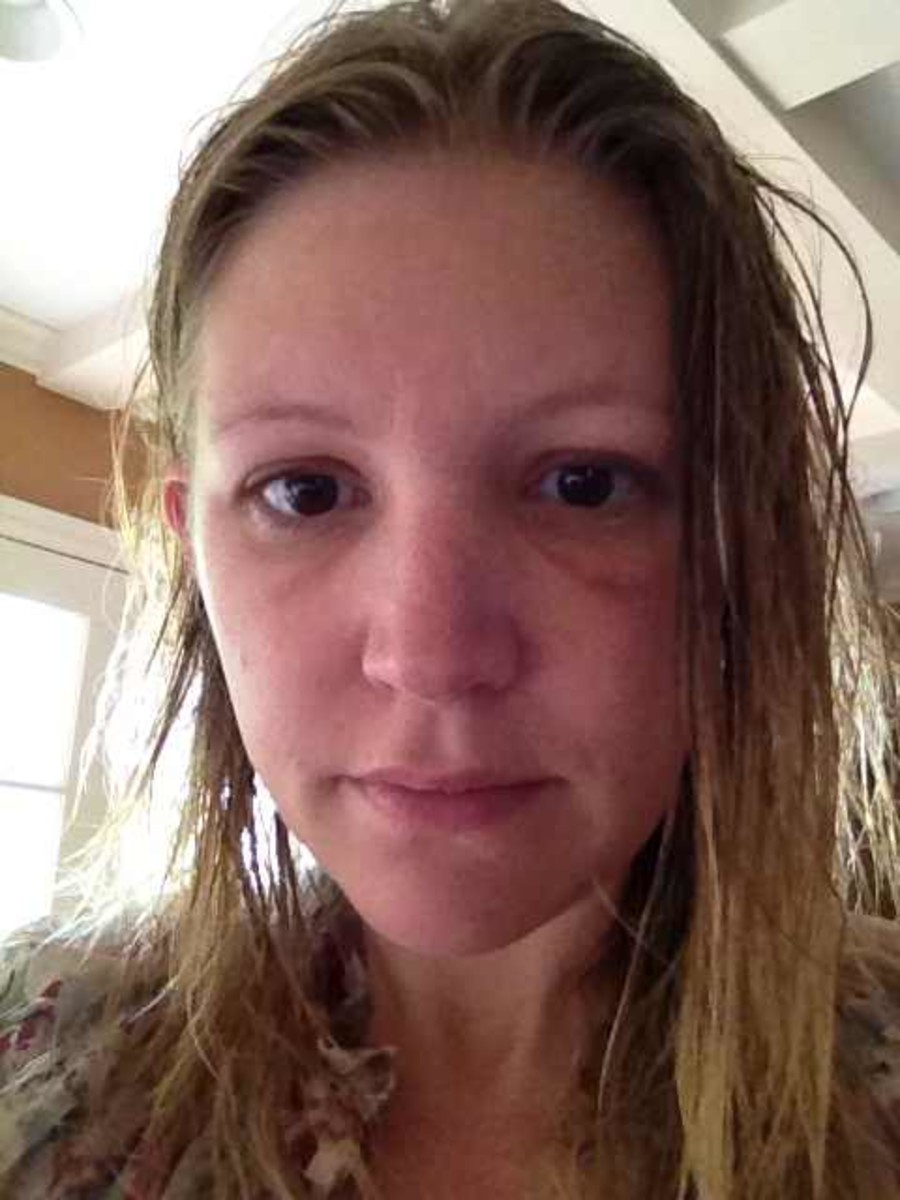 Treatments for a Bee Sting by Eye With a Photo Progression HealDove