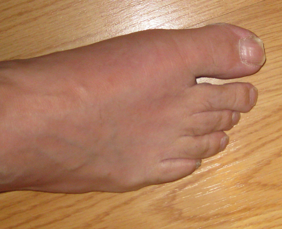Shoes That Work for Plantar Fasciitis Advice From a Fellow Sufferer