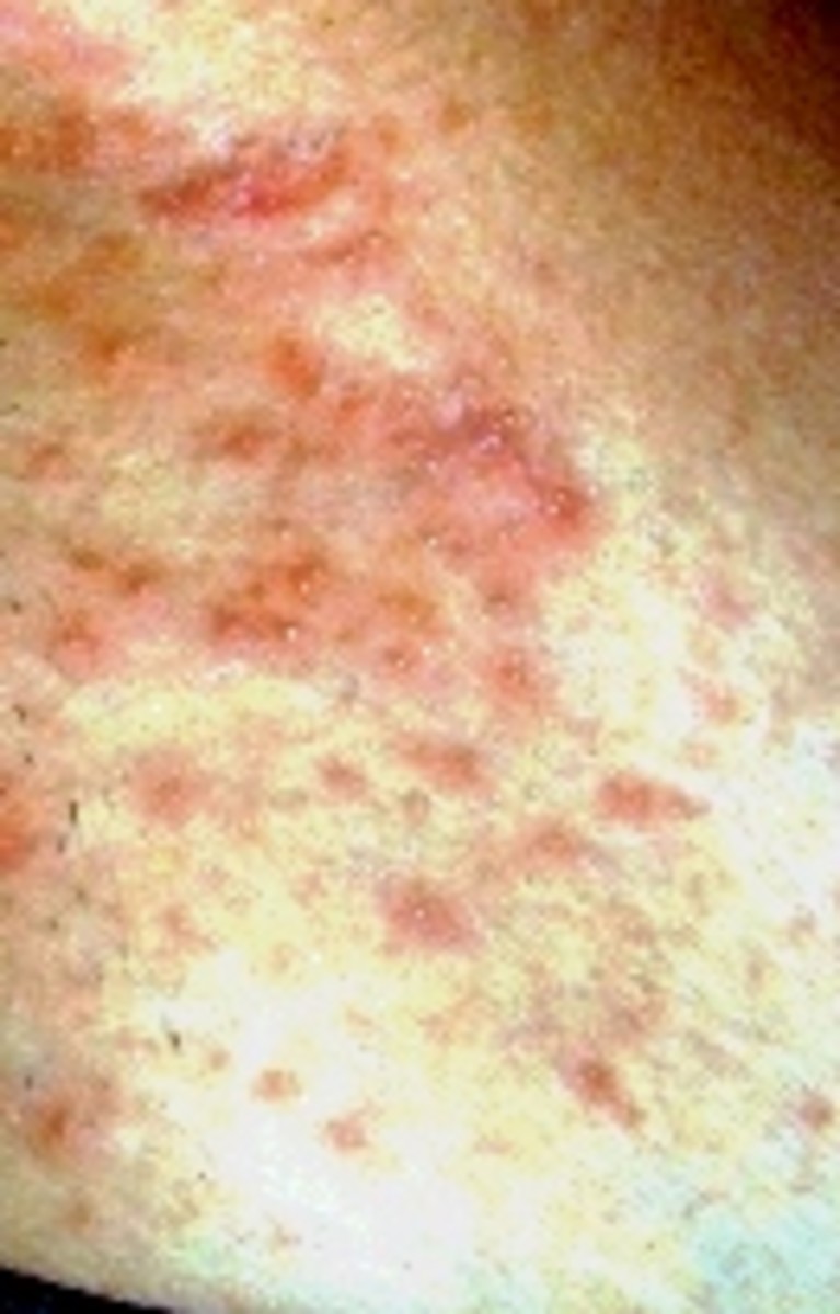 Allergic reaction to Deet Mosquito repellent What is the cure?