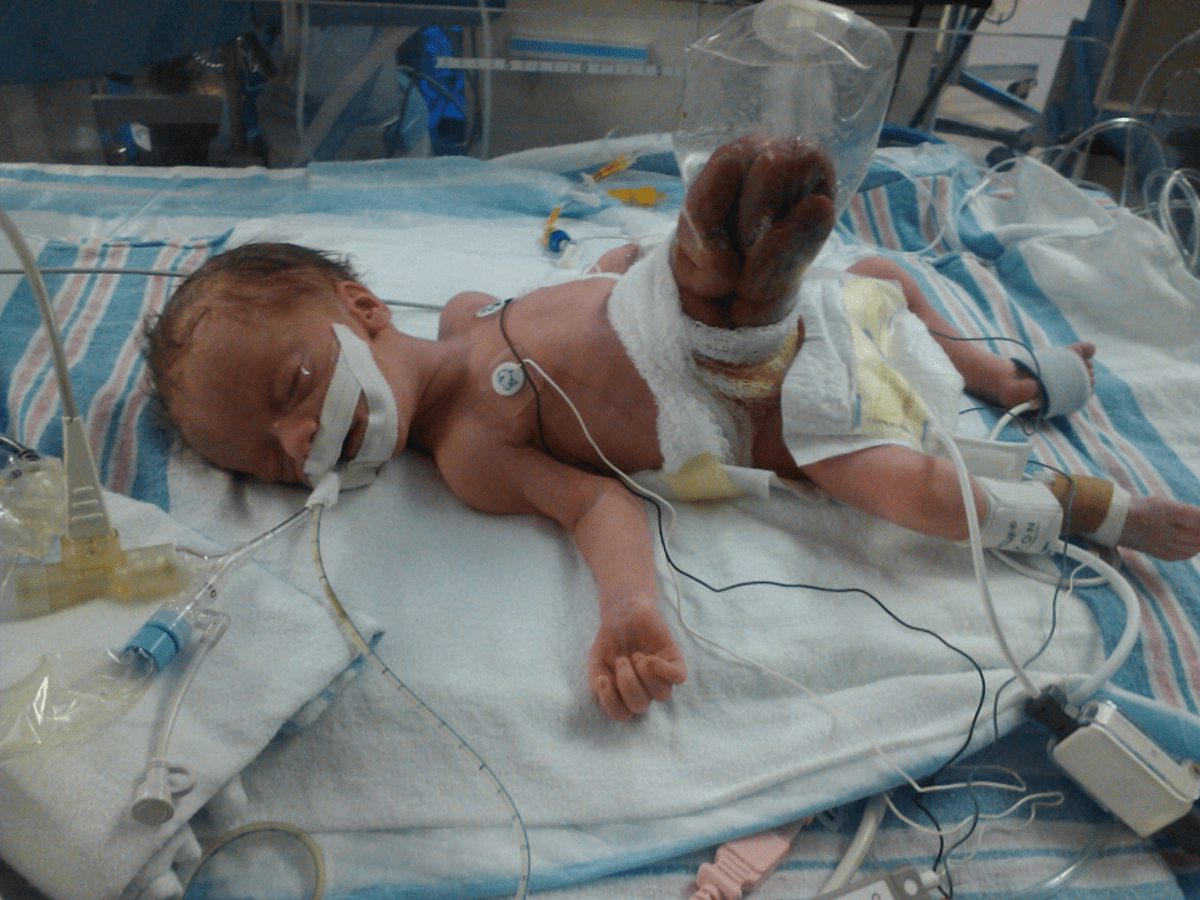 Being a Gastroschisis Dad hubpages