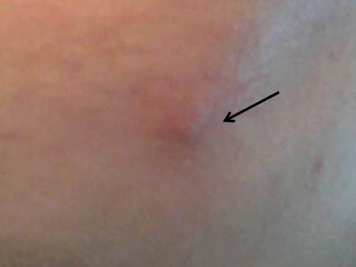 Skin Conditions During Pregnancy WeHaveKids