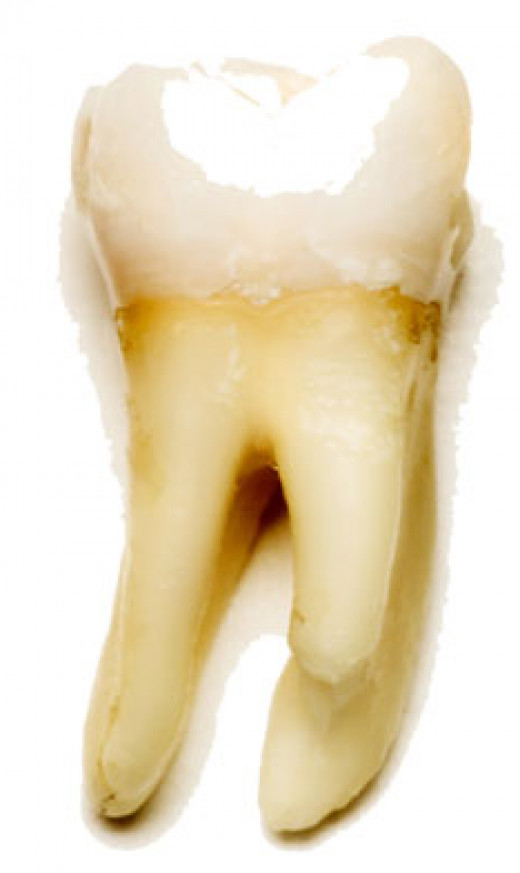 Temporary Emergency Cavity Toothache Relief Until Dentist Appointment