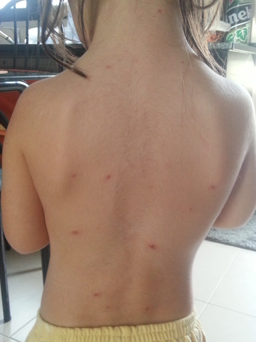 Chickenpox in children Tips and advices HubPages