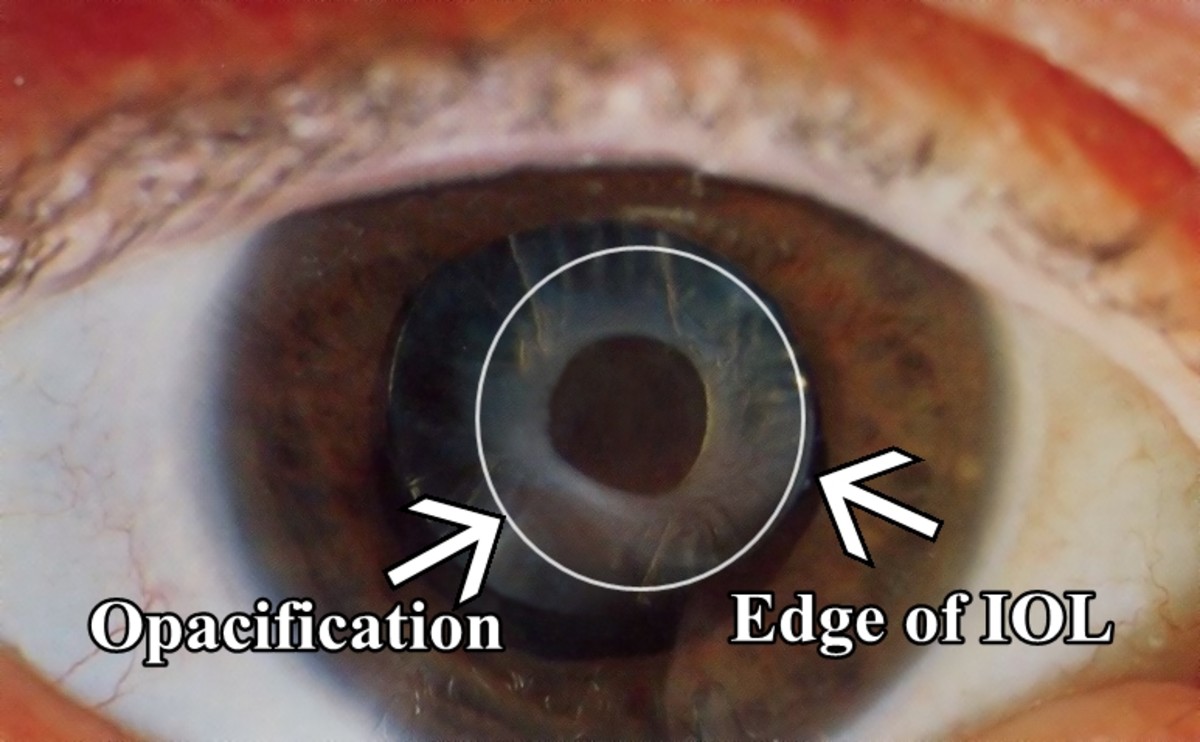 Definition of YAG Laser Posterior Capsulotomy HealDove