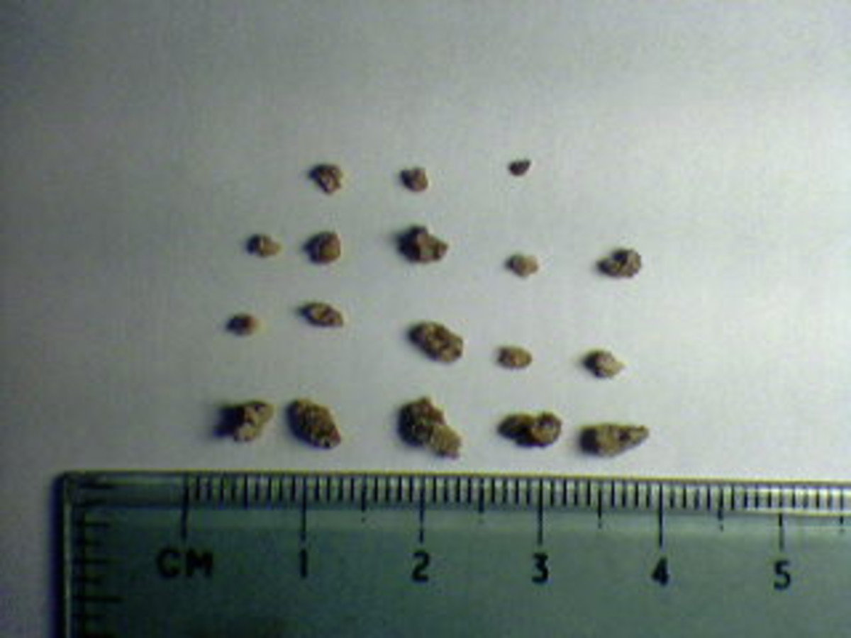 Rye Bread Kidney Stones at Noah Williams blog
