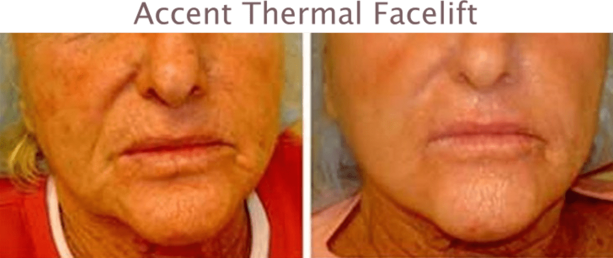 What is Thermal Face Lift? HubPages