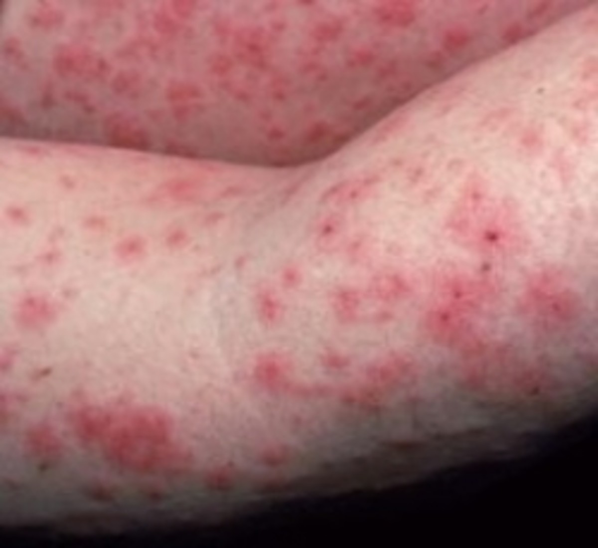 P.U.P.P.S...A Pregnancy Rash hubpages