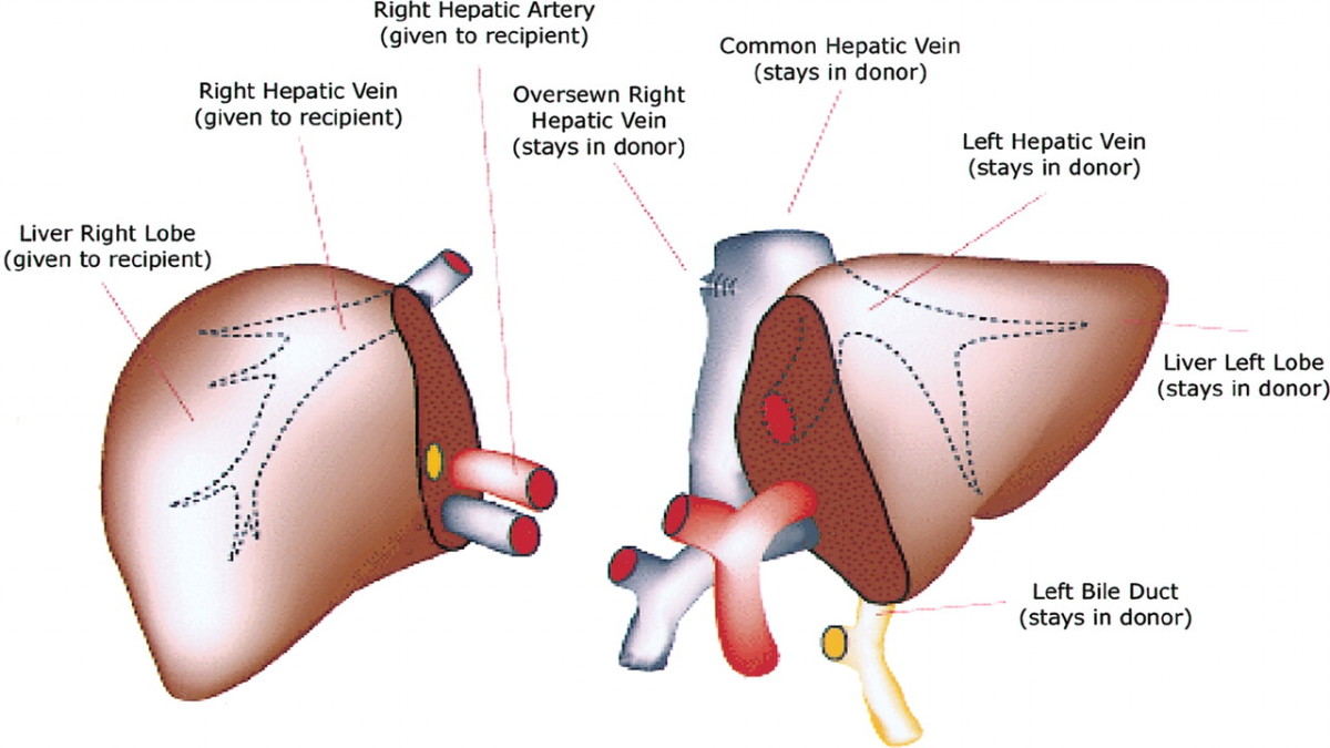 What is Liver Transplant How and Why it is done? HubPages