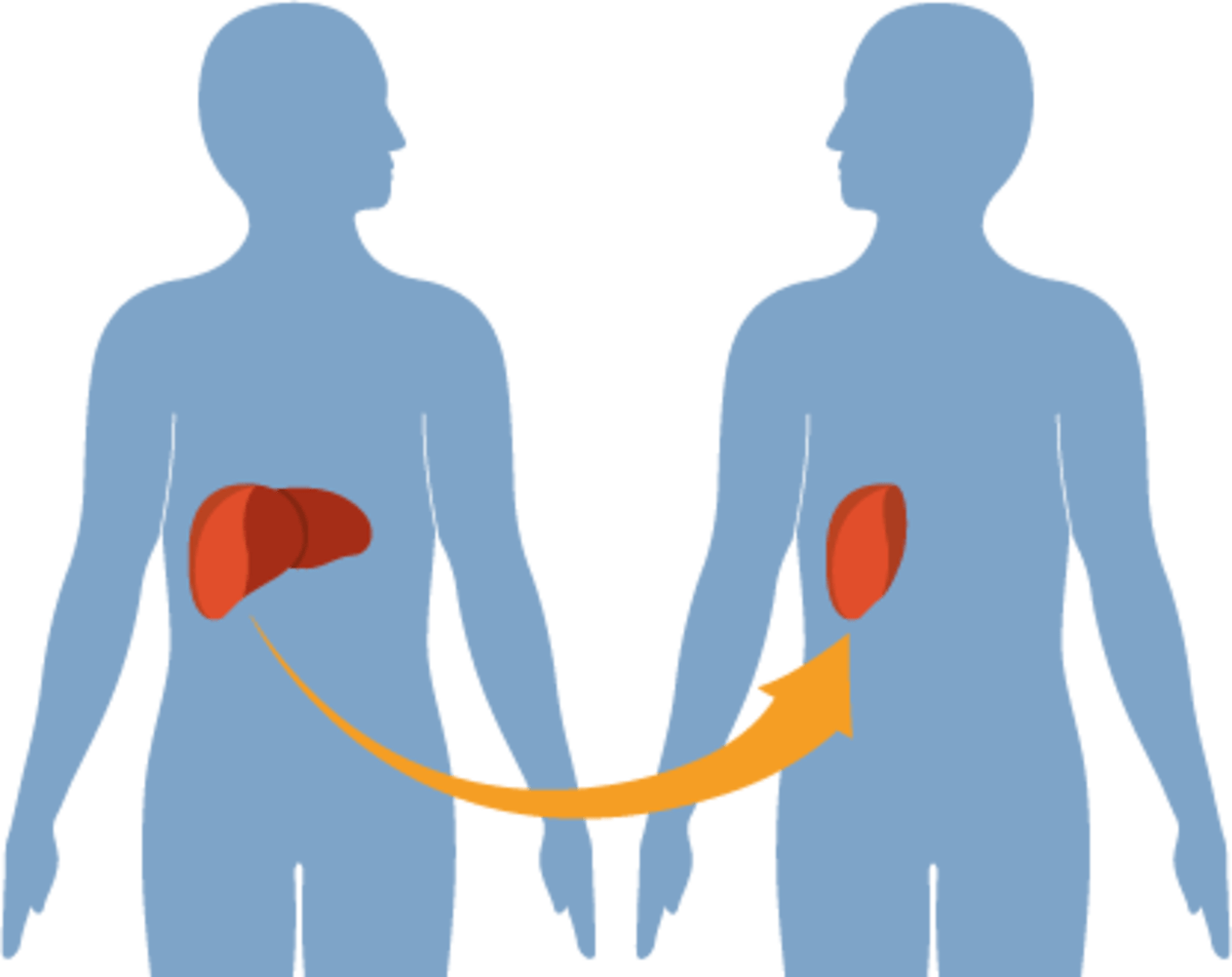 What is Liver Transplant How and Why it is done? HubPages