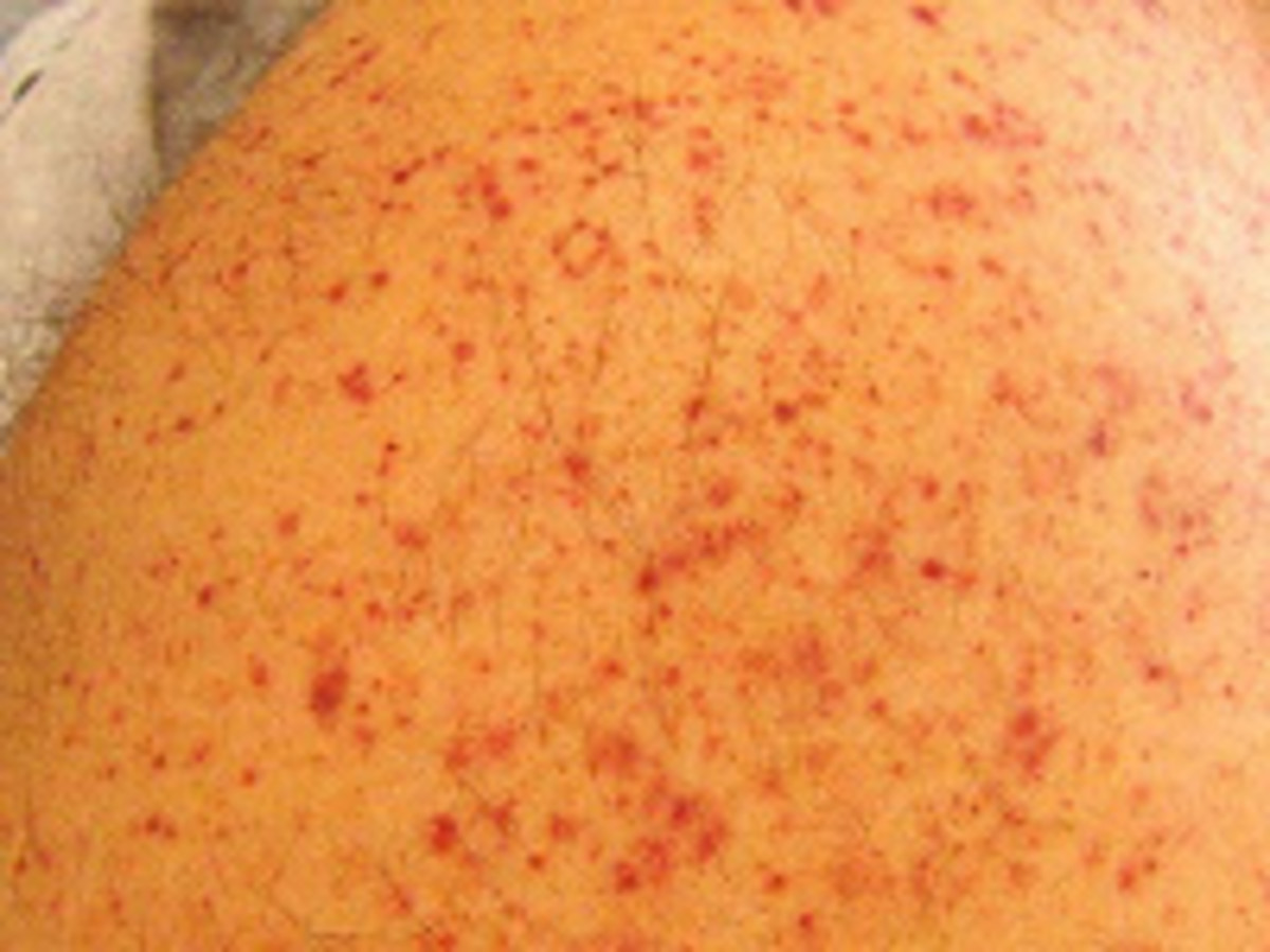 Low Platelet Count My Blood Stopped Clotting.