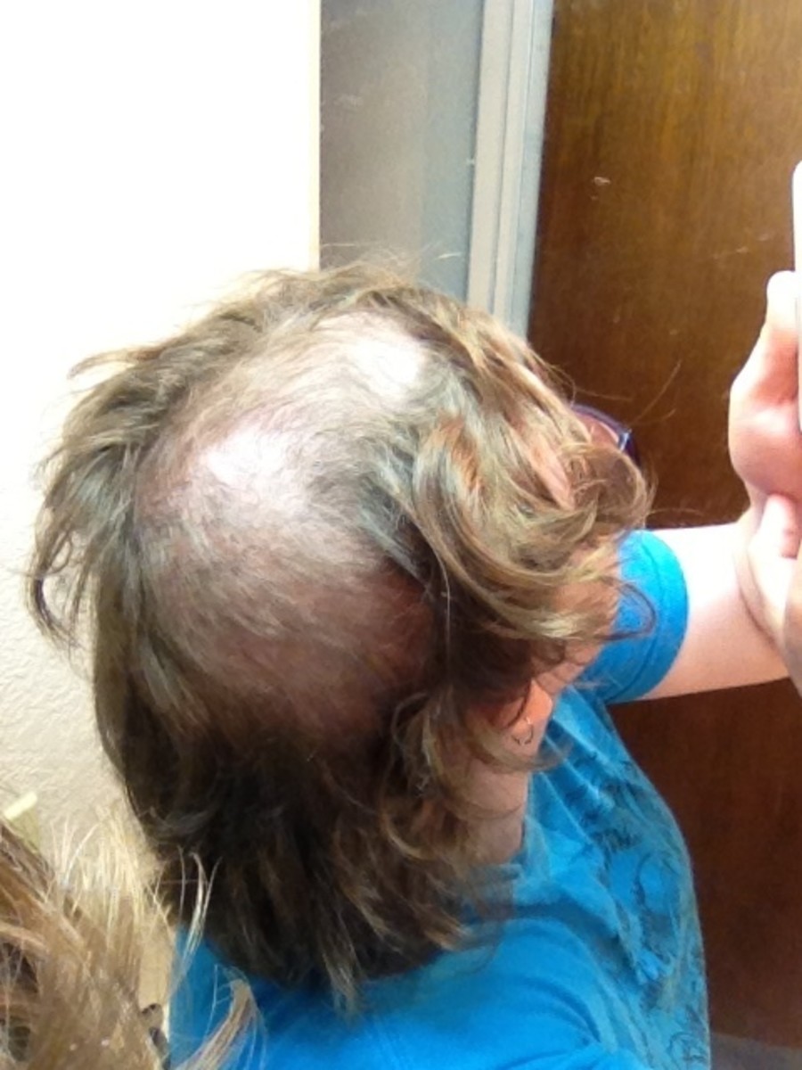 HairPulling, What it is Like, and THE CURE. HubPages