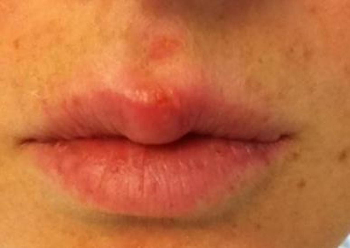 How to Get Rid of a Cold Sore Fast Home Remedies With Pictures HubPages