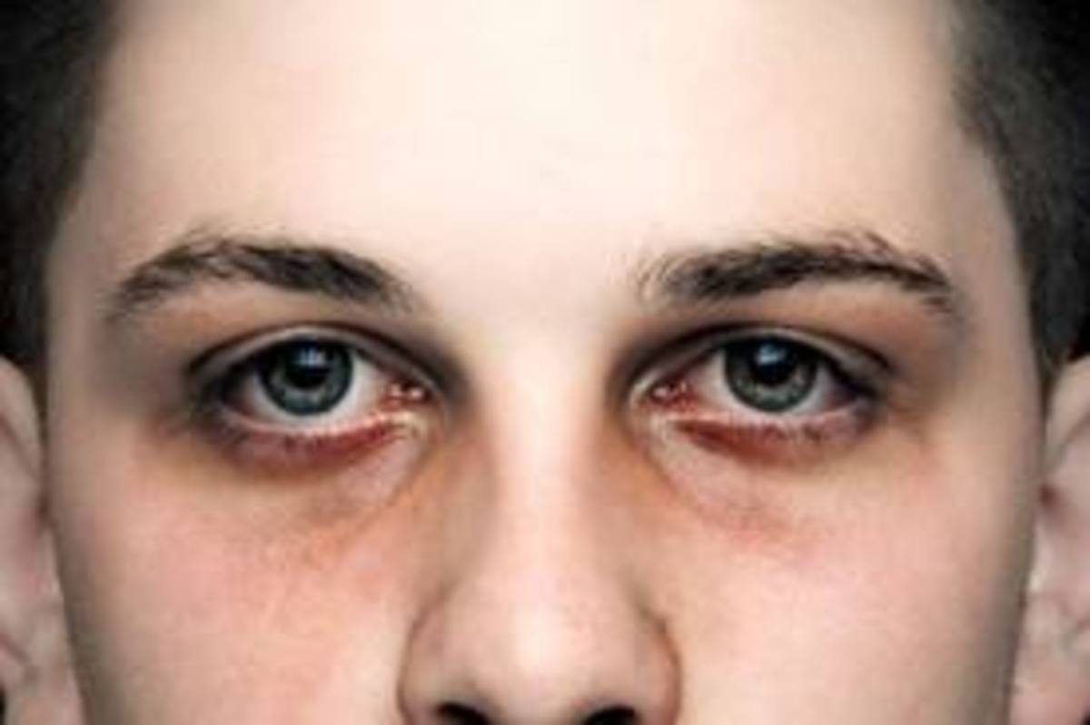 16 Easy & Quick Ways to Get Rid of Dark Circles Under Eyes Permanently