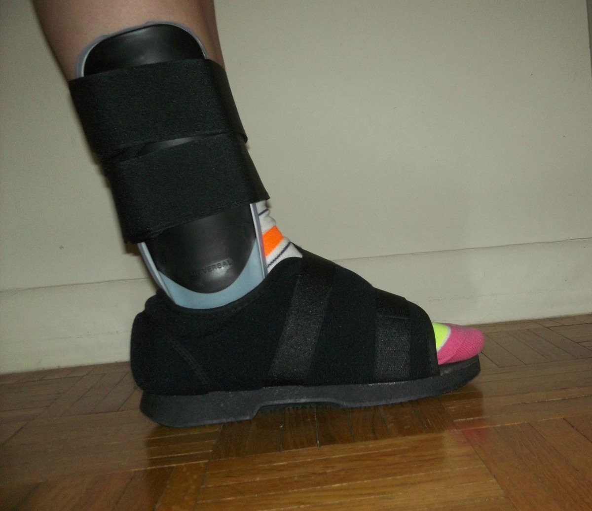 Broken Ankle Screw and Plate Removal Surgery Yes or No? HealDove