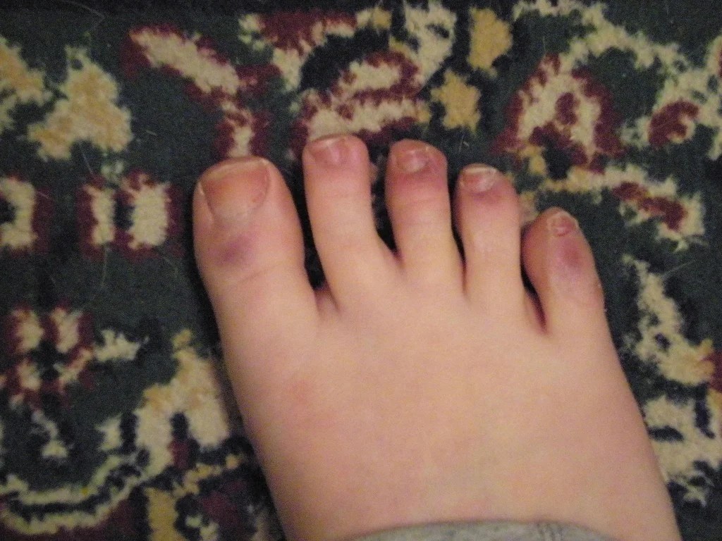 Vasculitis A Diagnosis In Progress hubpages