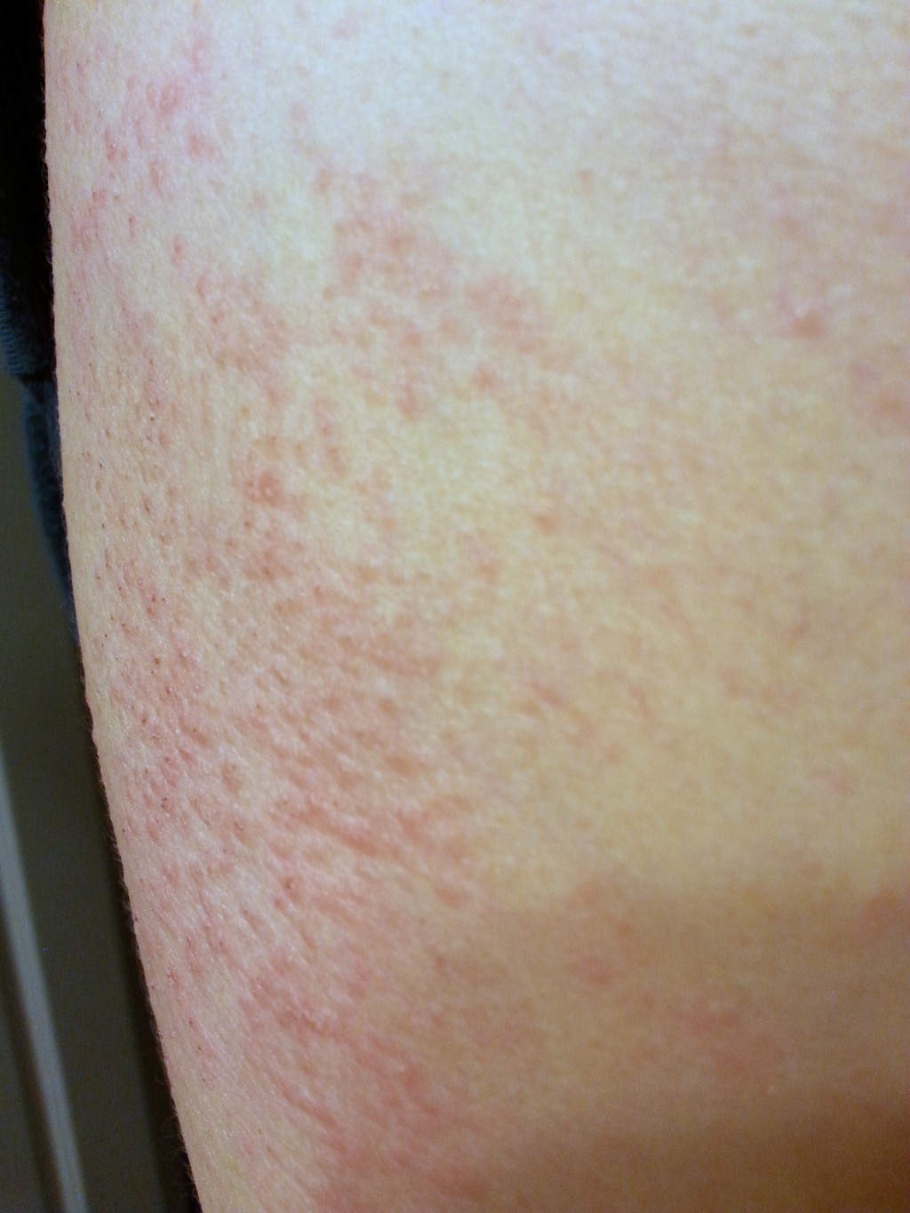 Valley Fever Does Cause Rash Diary Of A Survivor HubPages