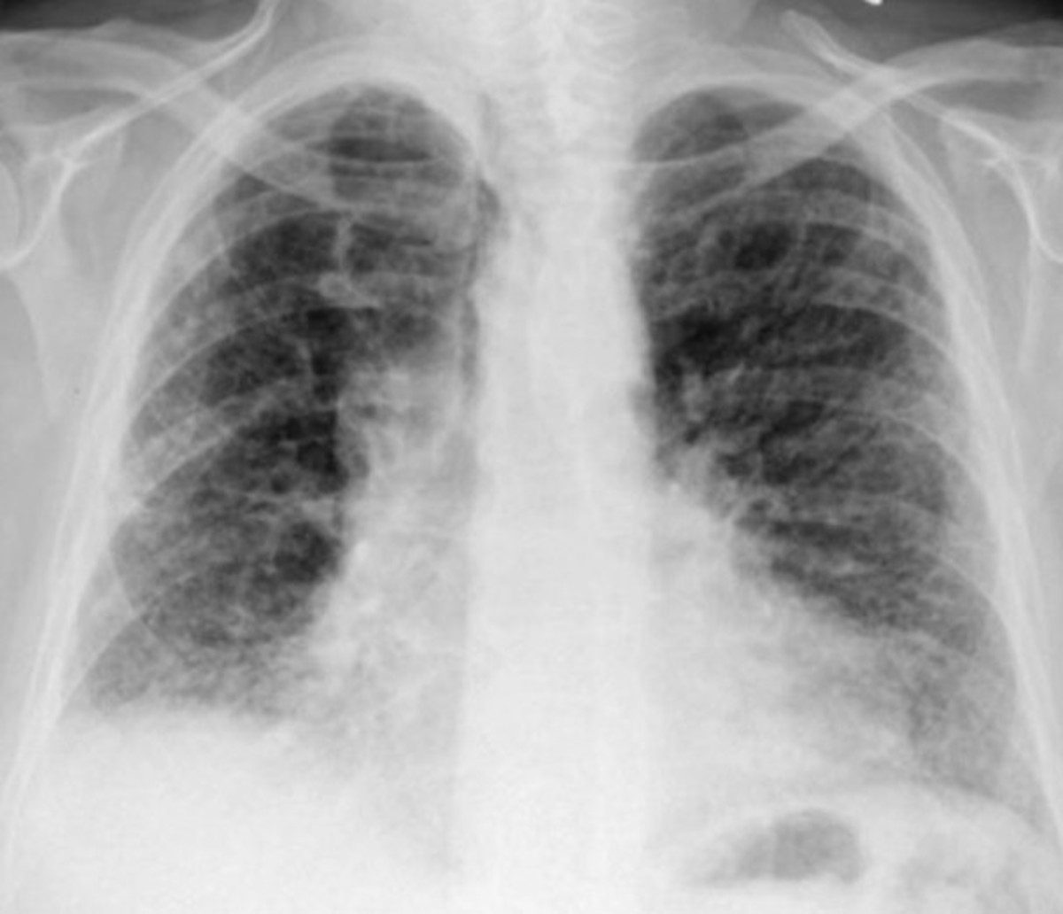 Interstitial lung disease Life Expectancy, Prognosis, Treatment