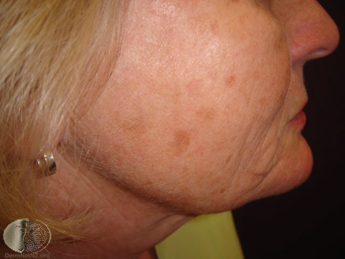 Information on senile lentigines brown spots on hands, face and body