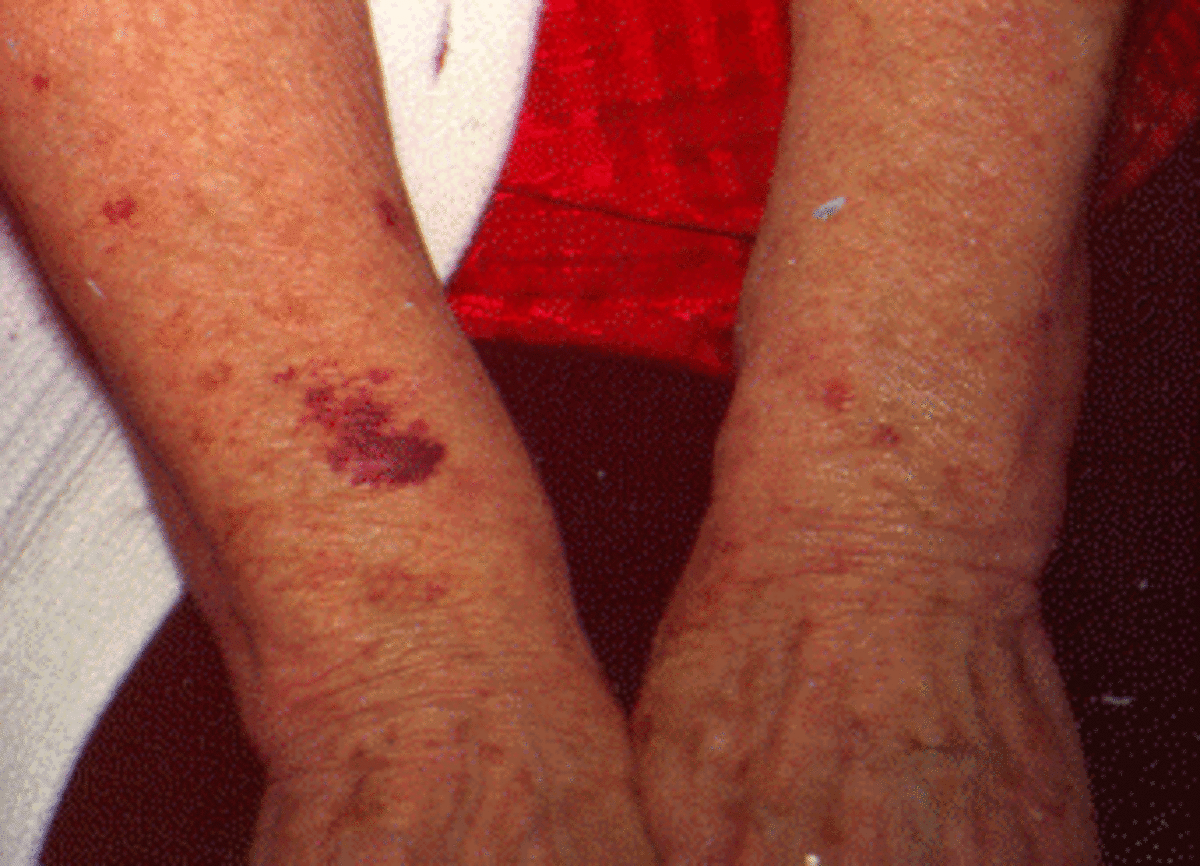 Causes of senile purpura Information and symptoms of senile bleeding