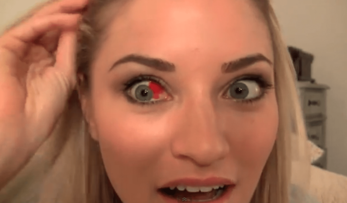 Burst blood vessel in eye Symptoms, Causes, Treatment HubPages