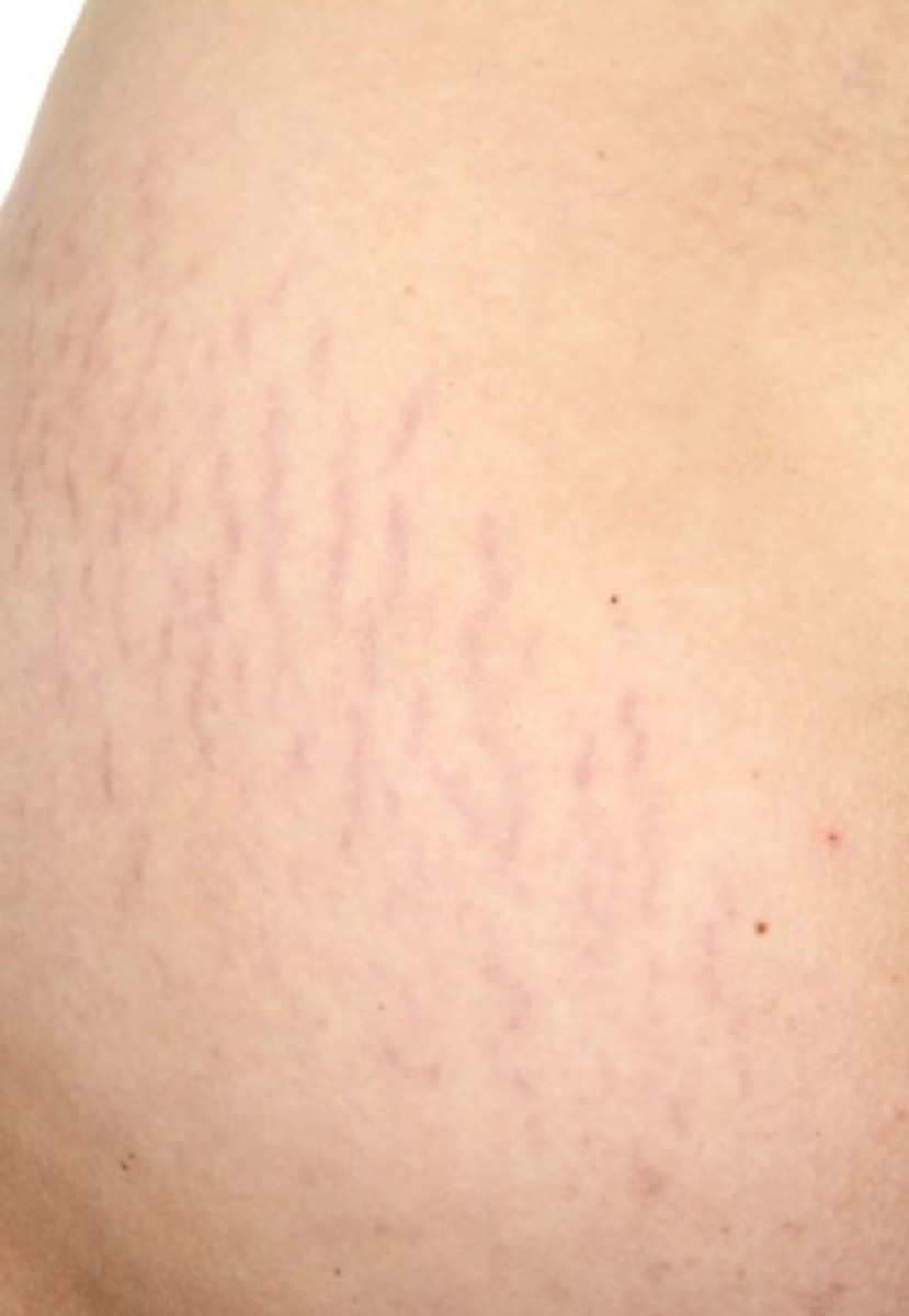 Coconut Oil For Stretch Marks