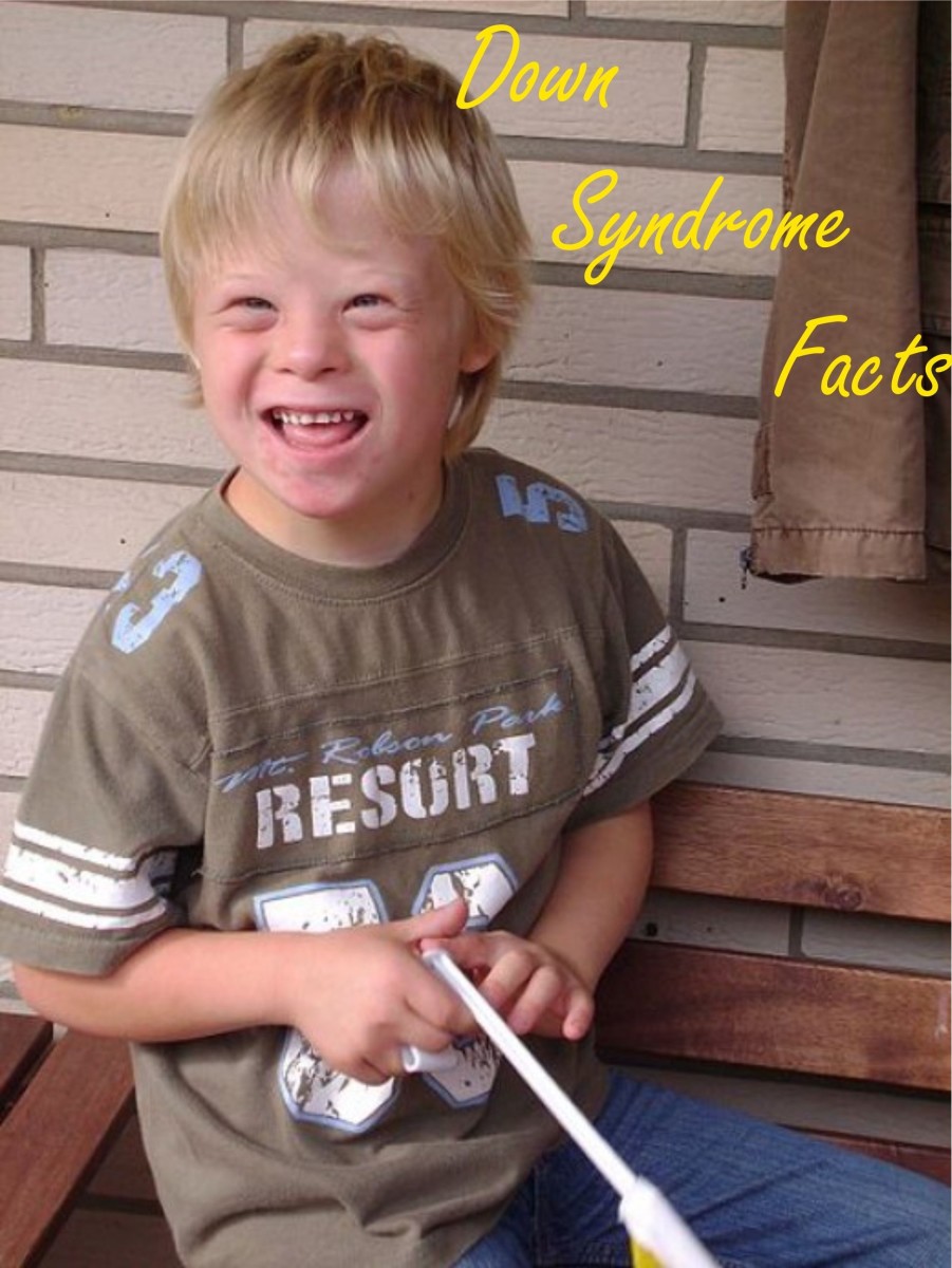 What Is Down Syndrome Facts and Symptoms HubPages
