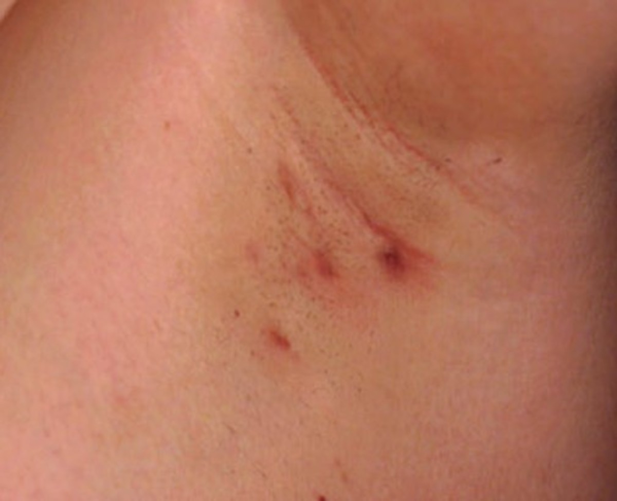 Hidradenitis Suppurativa Pictures, Symptoms, Treatment, Causes, Surgery