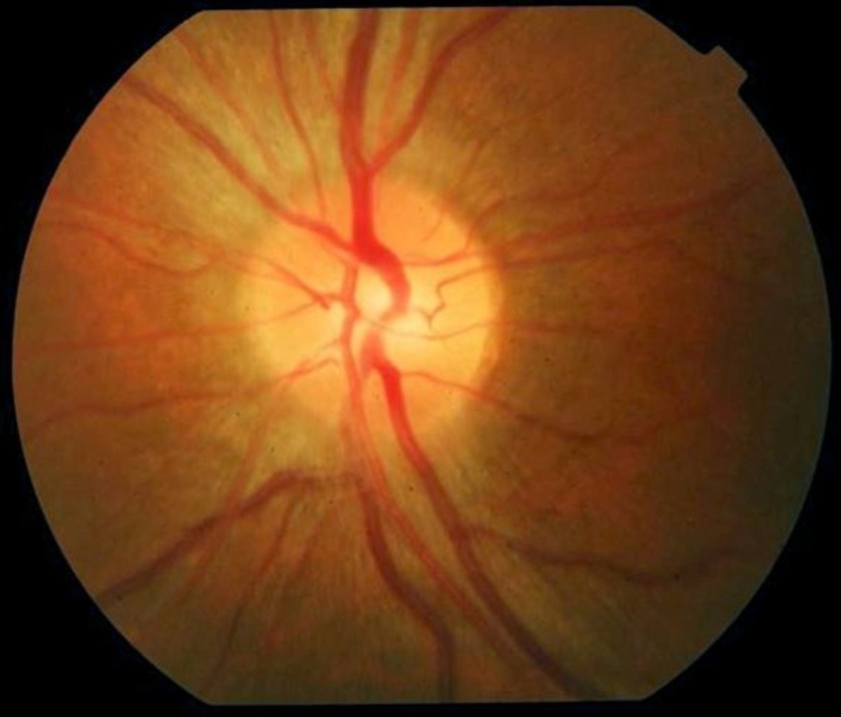 Optic Neuritis Pictures, Symptoms, Causes, Diagnosis, Treatment HubPages