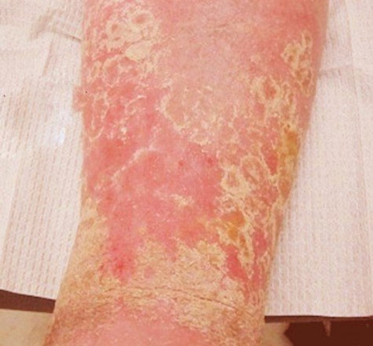 Stasis Dermatitis Pictures, Symptoms, Causes, Treatment, Diagnosis