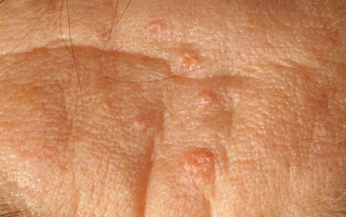 Sebaceous Glands Pictures, Function, Types, Location HubPages