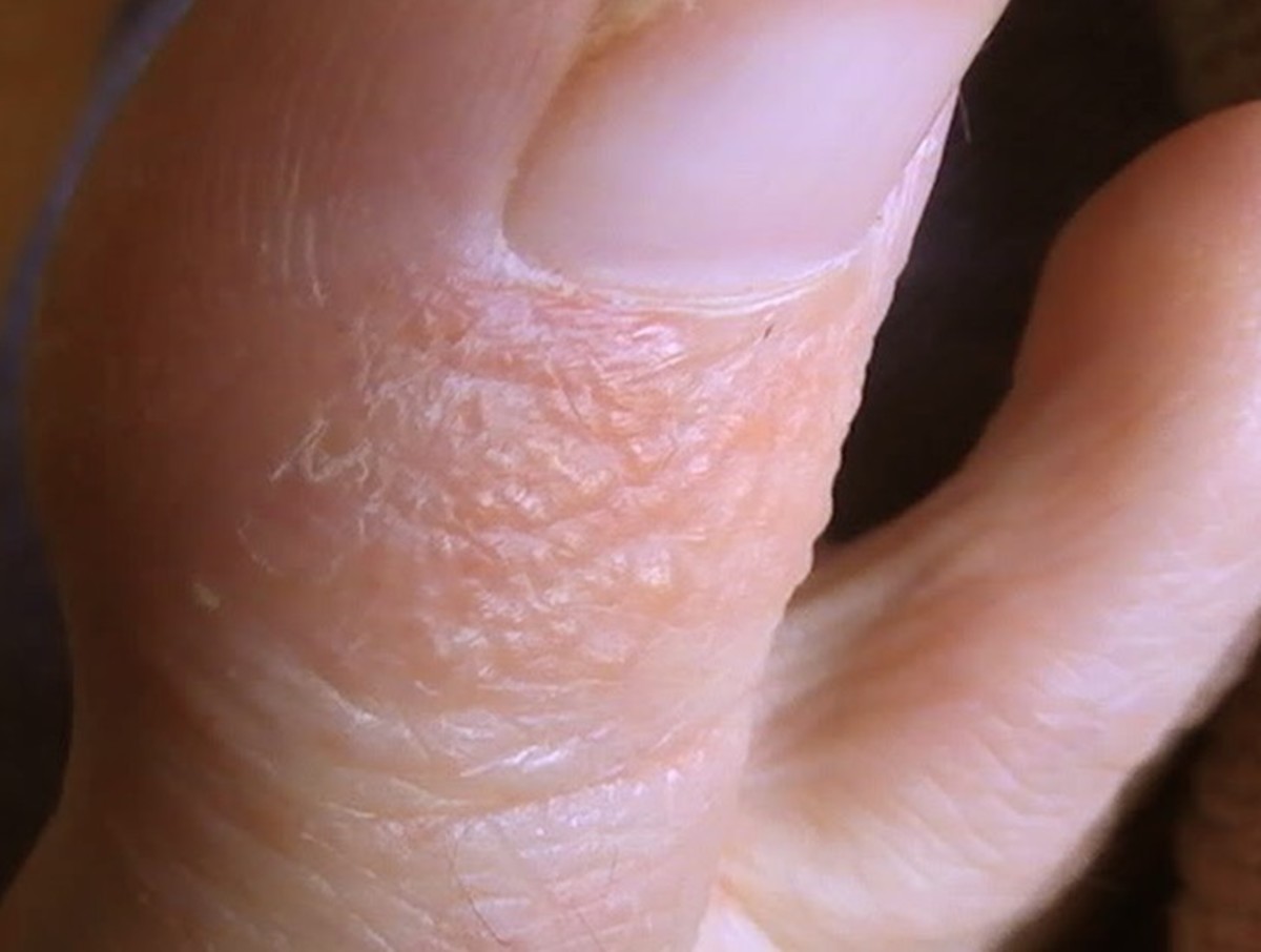 What Causes Little Water Blisters On Feet Printable Templates Protal