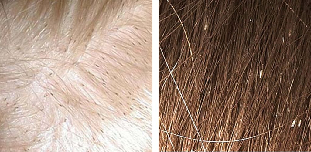 Getting Rid of Head Lice The Long Struggle hubpages