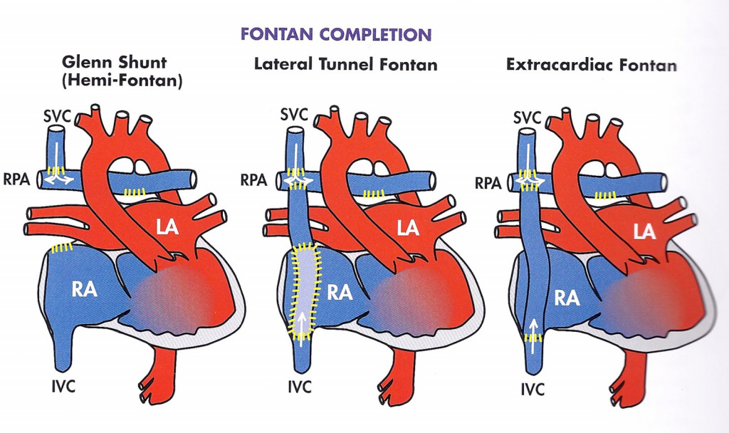 Left To Right Shunt Lesions Atrial Septal Defect (ASD) hubpages
