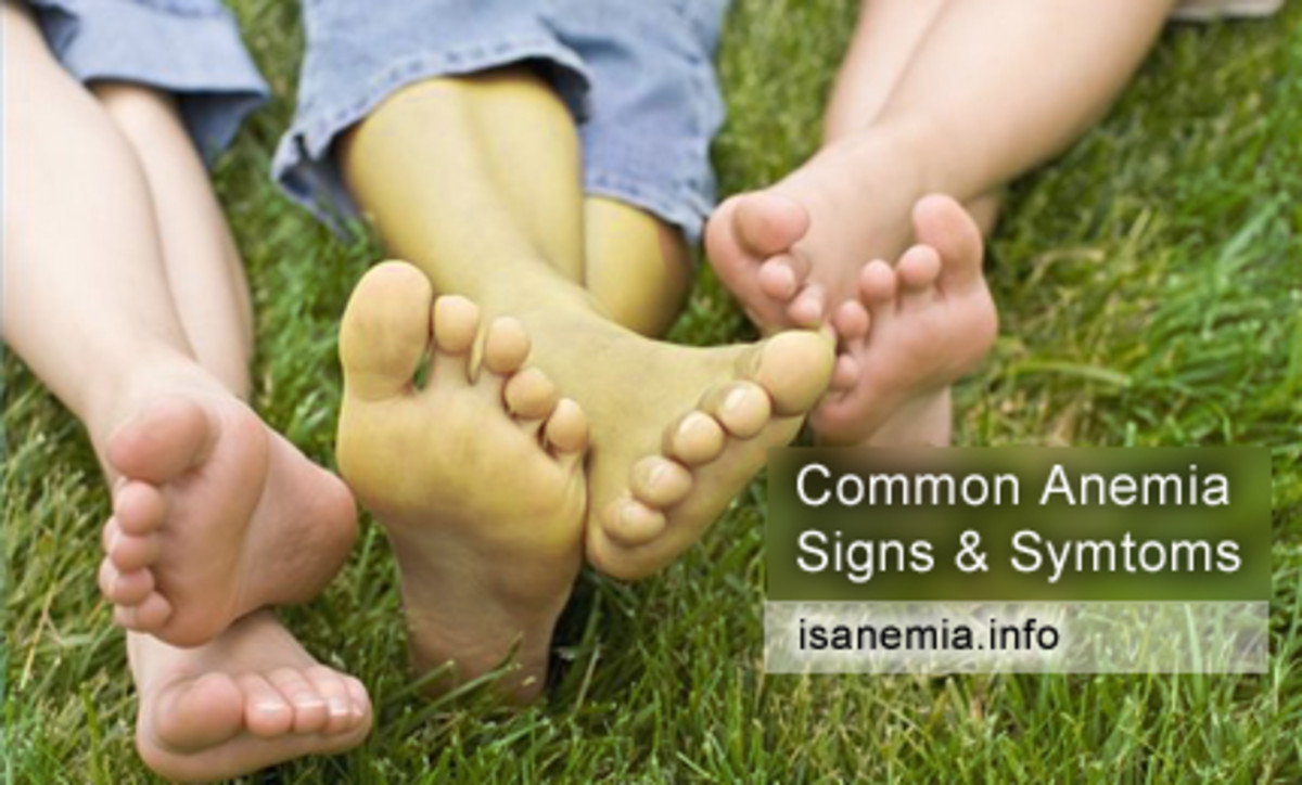 Microcytic Hypochromic Anaemia Iron Deficiency Anaemia As A