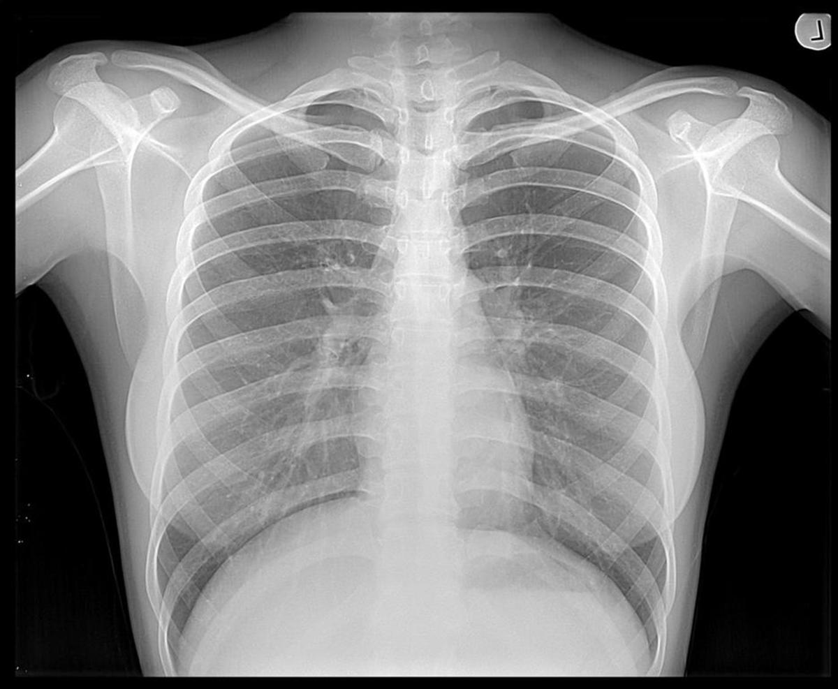 Reading The Chest XRay (Chest Radiography) Identifying A Normal Chest