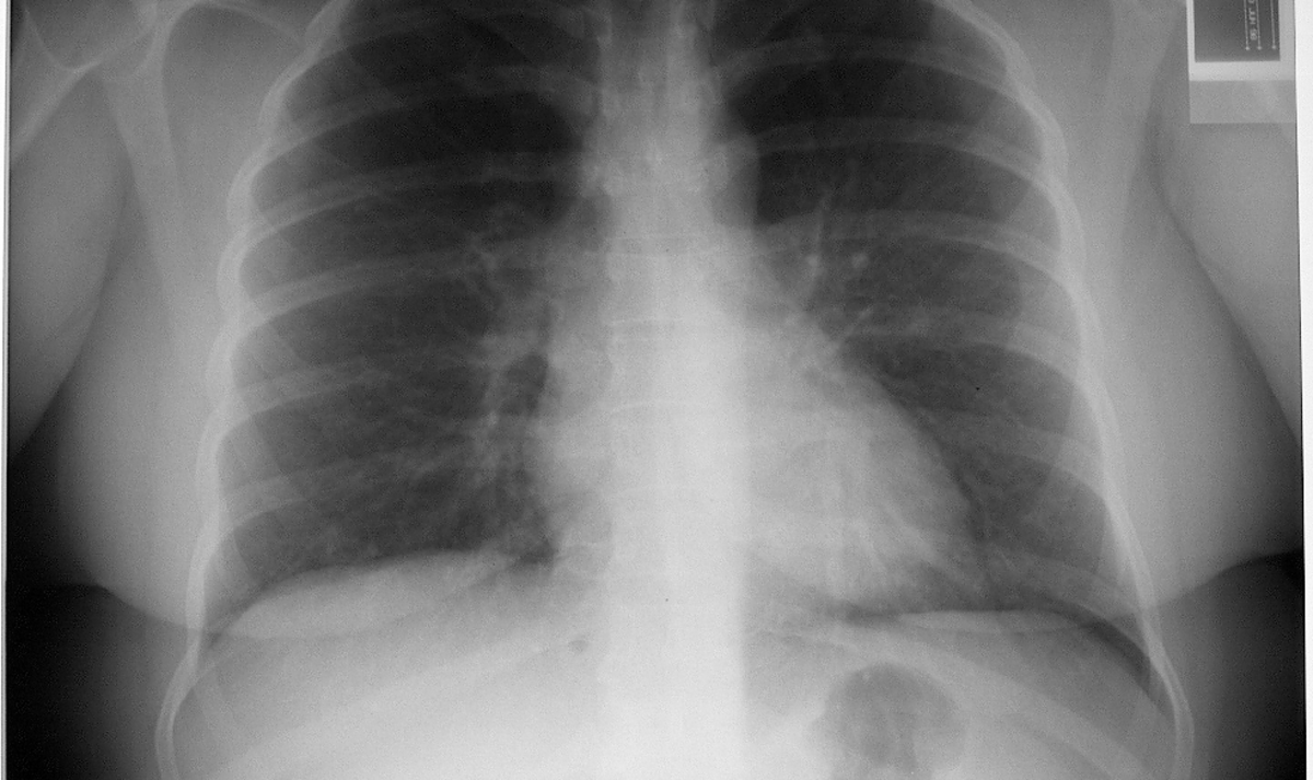 Reading The Chest XRay (Chest Radiography) Identifying A Normal Chest
