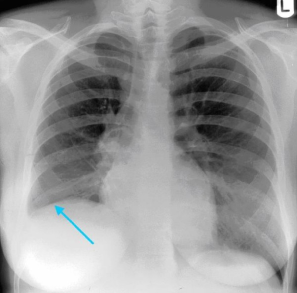 Diagnosing, Acquainting And Identifying With Atelectasis Via An XRay