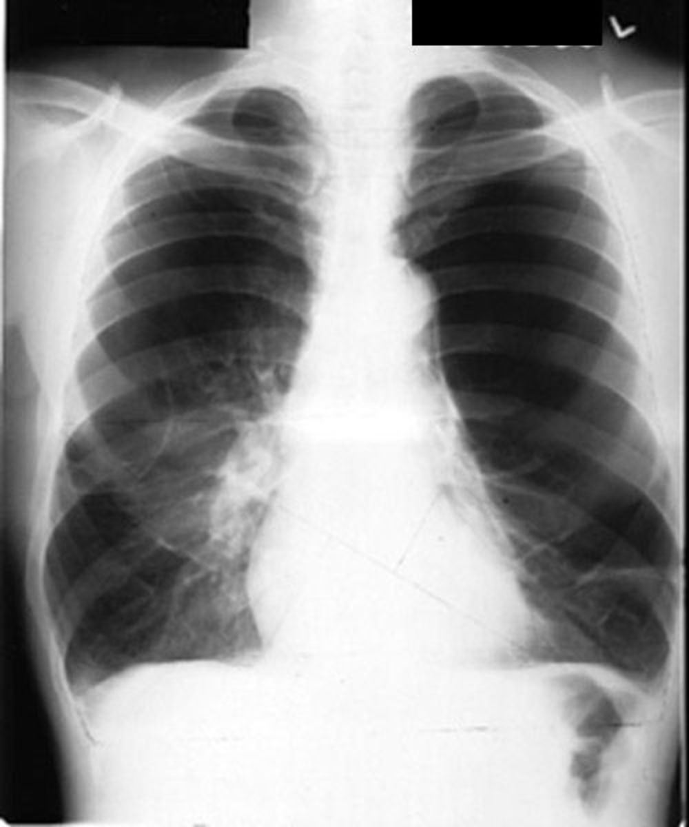 Detecting And Diagnosing Using The Chest XRay (Radiographic