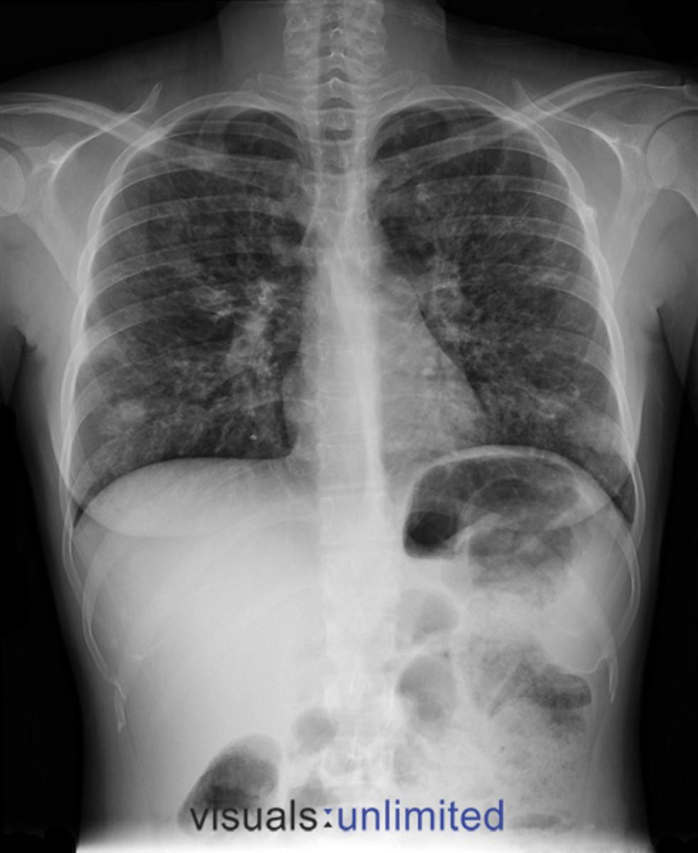Radiographic Representation Of Lung Cyst (Lung Cancer) Through Various XRays hubpages